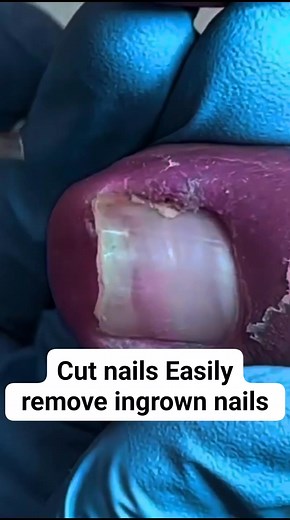 7 Cut nails Easily remove ingrown nails #ingrowntoenail #ingrowntoenailremoval #nails #nailart #podologia #unhaencravada #podologa #podologo | Dr Fod