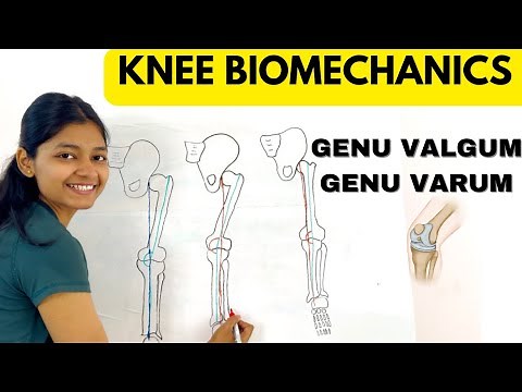 KNEE VALGUM & KNEE VARUM | KNEE BIOMECHANICS | PHYSIOTHERAPY