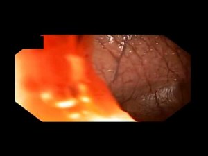 Íleon, tumores benignos, adenoma (PAF) • Vídeo • MEDtube.es