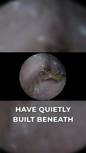 Huge Earwax & Keratin Blockage Unravels During Removal | Wax Off Short Episode 85
