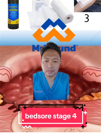 bedsore stage 4 #wound #elderly #stroke #cancer #braininjury #orthopedic #woundcare #sugat