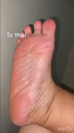 My skin is literally peeling off 👣 Watch the full peel on my channel!
