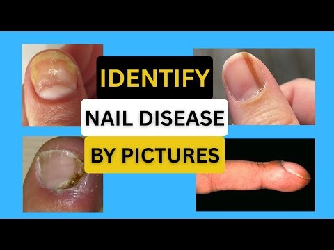 What Your Nails Reveal About Your Health | Common Nail Diseases Explained Through Pictures