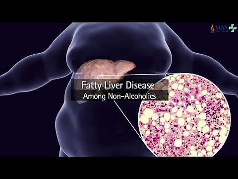 Liver Fibroscan - A smarter alternative to Liver Biopsy l Max Hospital, Pitampura