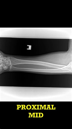 X-Ray Findings Metal Foreign Bodies - Case Short