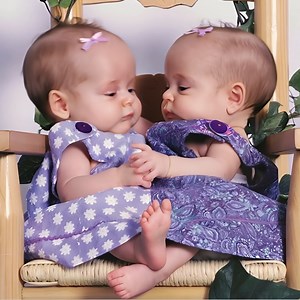 👧👧 These Siamese twins were separated 18 years ago, and everyone believed they wouldn’t survive. 😢 Today, after years of struggle, they’ve proven that miracles are real. ✨ 📌 See how the sisters live now – the touching story is in the comments. 👇👇👇 | Nice Nature
