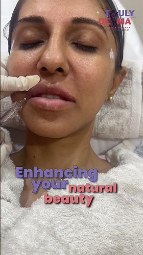 Lip Filler Process | Step-by-Step Procedure | Truly Derma