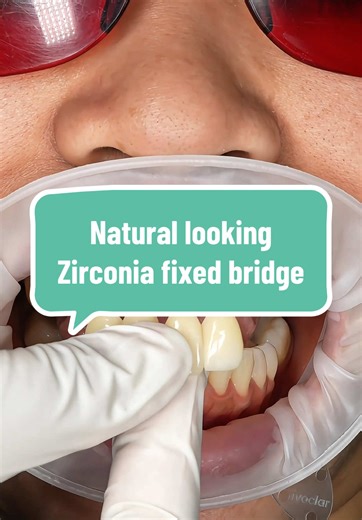 Transform Your Smile with Zirconia Fixed Bridges