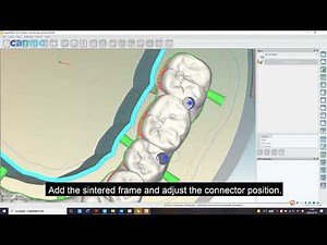 CMD 500 Software Nestting Guidance Video: Implanting Bridge Hyperdent