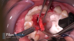 Extraction Socket Graft with Connective Tissue Graft
