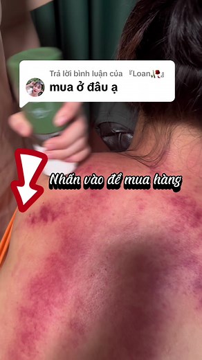 Trả lời @『Loan🥀』 Dạ con lăn siêu hot nhà em đây ạ, ai muốn sở hữu em nó thì click vào giỏ hàng ngay nhé 🥰🥰🥰 Giảm mỏi người siêu hiệu quả lun ạ!!! @Dưỡng Sinh Cô Ba Shop #conlantrilieu #conlanmassage #kemmassage #duongsinhcoba