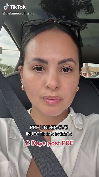 PRF Under-Eye Injections: Before and After Results Revealed!