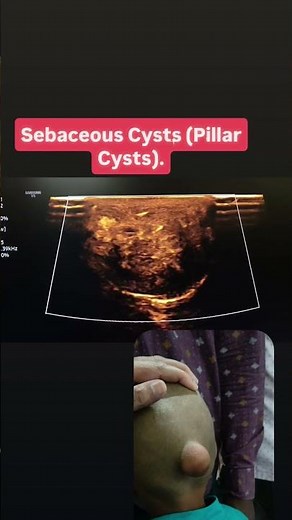 Sebaceous Cysts (Pillar Cysts). #ultrasound ‪@drpravingupta‬‪@AlanChikinChow‬