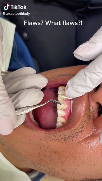 Front teeth flaws fixed with bonding 👍#toothbonding #frontteeth #cosmeticdentistry #compositebonding #veneers #houstondentist #tootherosion #fyp #trending #fy (713) 621-5141