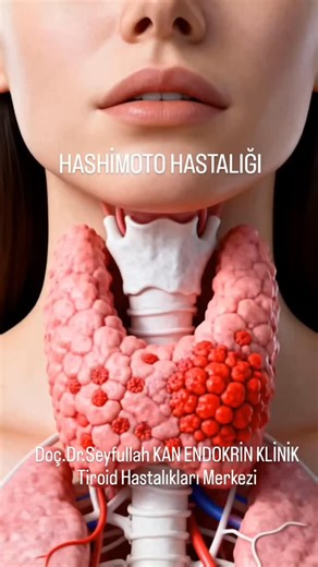 Doç.Dr. Seyfullah KAN▪SAĞLIKLI KİLO VERME PROGRAMI▪ANTI-AGING▪🇹🇷 on Instagram: "Hashimoto hastalığı, otoimmün dediğimiz yani vücudun bağışıklık sisteminin kendi dokularına savaş açtığı bir hastalıktır. Şehir hayatının getirdiği bir hastalık da diyebiliriz. Şehir hayatında hergün farkında olarak ya da olmadan maruz kaldığımız plastikler, kozmetikler, egzoz baca dumanları, sigara, alkol, deterjan, diş macunları...gibi binlerce madde bu otoimmüniteyi tetiklemekte. Hastalığın tedavisinde bütüncül 