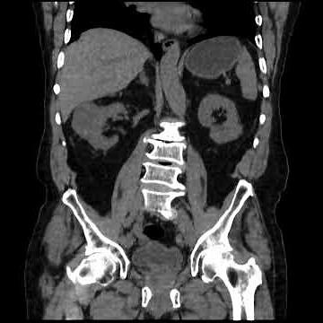 Tomografía de abdomen simple y contrastda. Abomen CT Scan #anatomy