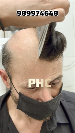 Permanent Hair Patch Delhi | Hair Wigs For Men￼ | 📞 9899746489 #wigs #hairtransformation #hairpatch