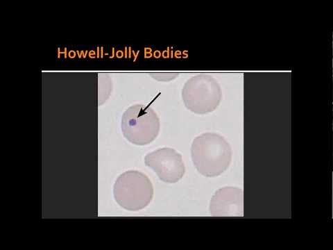 Red Blood Cell Disorder -- Heinz bodies, Howell-jolly bodies, basophilic stippling & Reticulocytes