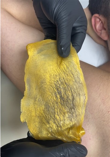 𝗠𝗘𝗡𝗦’ UNDERARM WAX ✨ Elixir By Waxx.INN ✨ Pore bleeding during waxing happens when the hair is removed from the root and tiny blood vessels around the hair follicle are slightly disturbed. This is more common in areas with thicker, deeper hair because the follicle is larger and more firmly anchored in the skin, men tend to experience this more often because their hair is typically coarser, thicker, and rooted deeper due to higher testosterone levels, although it may look alarming, pore bleed