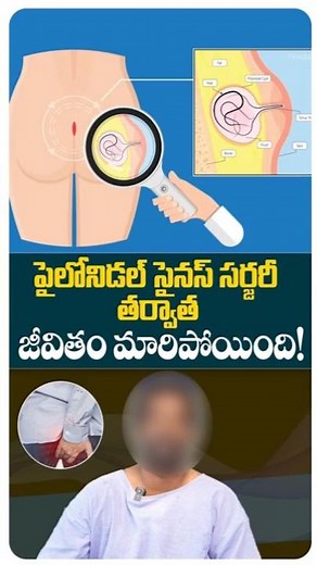 Buttock Hair Removal for Men | Prolonged Sitting Effect | #ytshorts #healthtips #pilonidalsinus