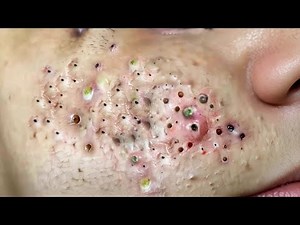 Extreme Blackhead Removal | Deep Pore Cleaning Facial | Satisfying