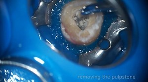 Removal of huge pulp stone in endodontics 😃☺☺. #Dentistry #The_Genius_prof About The Genius Prof: in comments. Source: in comments | The Genius Prof