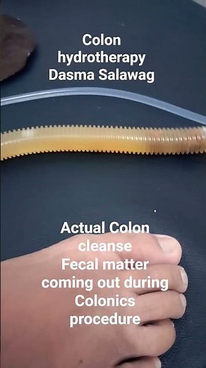 Colon Hydrotherapy Actual footage during colonics procedure