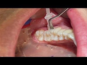 NEW Proximal Curodont Tutorial Hydroxyapatite Remineralization Minimally Invasive Cavity Prevention
