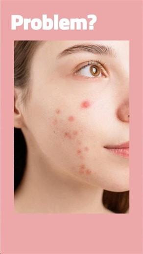 DIY Acne Treatment Face Mask | Rice Flour, Gram Flour, Turmeric & Aloe Vera #acne