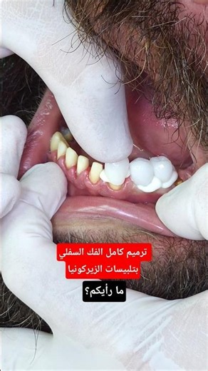 lower arch rehabilitation with dental zirconia crowns