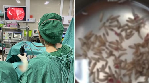 Thousands Of Maggots Found In Thai Woman's Blocked Nose: Here's What You Need To Know