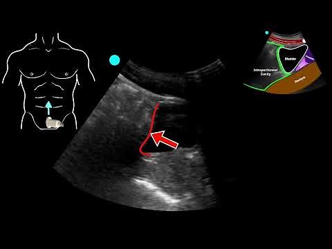 POCUS - Fall from ladder with lung point and pneumothorax