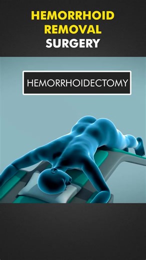 Hemorrhoid Removal Surgery Procedure Explained