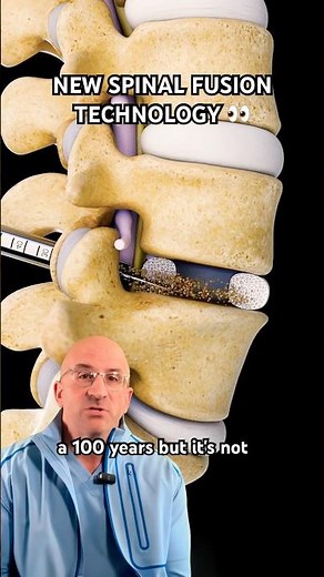 High-Tech Spinal Fusion for Back Pain Relief⁉️ #shorts