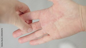 atopic dermatitis on hands dry itchy inflamed skin flare irritations on palm of hand. dry cracks on fingers inside, painful disease. red, dry patches skin female hand. neurodermatitis symptoms