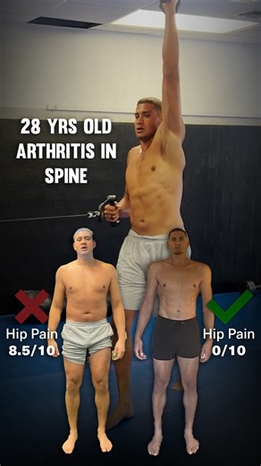 Functional Patterns on Instagram: "Alex came to FP after 10 years of conventional weight training and regular stretching methods. At only 28 years old, he was already dealing with serious structural issues that seemed crazy to be happening so young - an L5 anterolisthesis, beginning stages of arthritis in his mid back, and loss of cervical curve. Despite a decade of what he thought was proper training, his daily mechanics were poor and he was living with multiple dysfunctions. When Alex started 