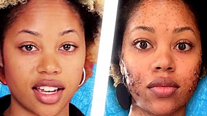 People Live With Acne For A Day | BuzzFeed Video