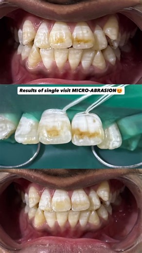 Dr. Tina Lohana, BDS, FCPS Resident on Instagram: "MICRO-ABRASION✅ #dentistlife #endodontist #dentistry #postgraduation #residentslife"