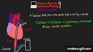 What is an Intra-Aortic Balloon Pump (IABP)? on Make a GIF