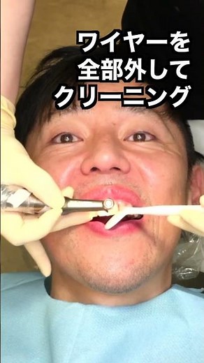 Real video of orthodontic wire adjustment | Pain and discomfort revealed! #shorts