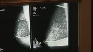 New guidelines for breast cancer screening