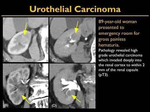 CT of Calyceal Abnormalities in the Kidney: Pearls and Pitfalls