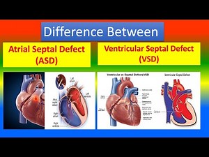 Difference between Atrial Septal Defect (ASD) and Ventricular Septal Defect (VSD)