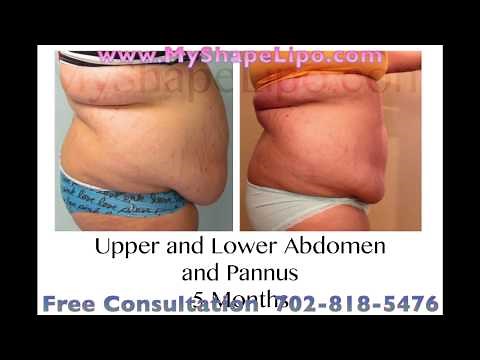 Large Volume Liposuction, Before and After, See Dramatic Results