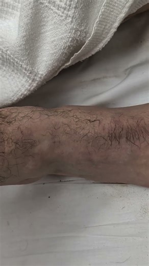 tib and fib first surgery in the morning #motocross #scarred