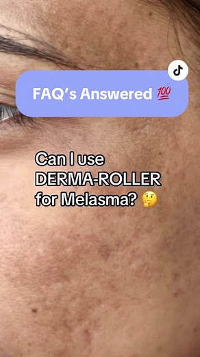 Melasma Treatment: Derma Roller Guide for Radiant Skin