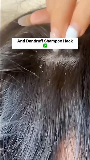 How to Remove Dandruff Fast | Best Anti-Dandruff Routine That Actually Works #dandruff #haircare