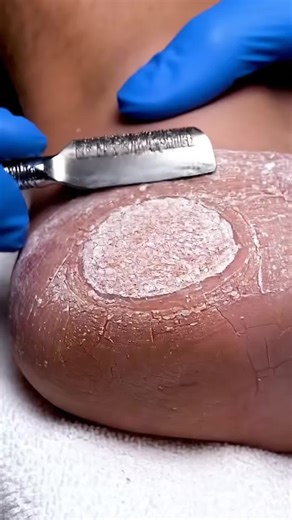 27K views · 30 reactions | Foot ASMR Detail | Satisfying Dry Skin Removal 18MT #footcare #heeleexfoliation #pedicure #oddlysatisfying #dryskinremoval Enjoy clean, relaxing foot-care ASMR with gentle heel exfoliation and natural callus removal. Disclaimer: AI-generated educational & relaxation content. | Path to Jannah | Facebook