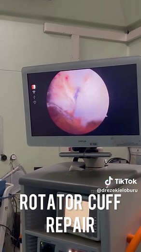 One of the procedures I really enjoy - arthroscopic repair of both the subscapularis and supraspinatus tendons 💪🏽🔧 Restoring shoulder strength and function through tiny portals and big precision 🎯🎥 #RotatorCuffRepair #Subscapularis #Supraspinatus #ShoulderArthroscopy #OrthoSurgery #Orthopaedics #MinimallyInvasive #DrEzekielOburu