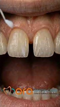 Close Your Front Tooth Gap Without Braces. Cosmetic Composite restoration at Ora Dental Care, Mysuru
